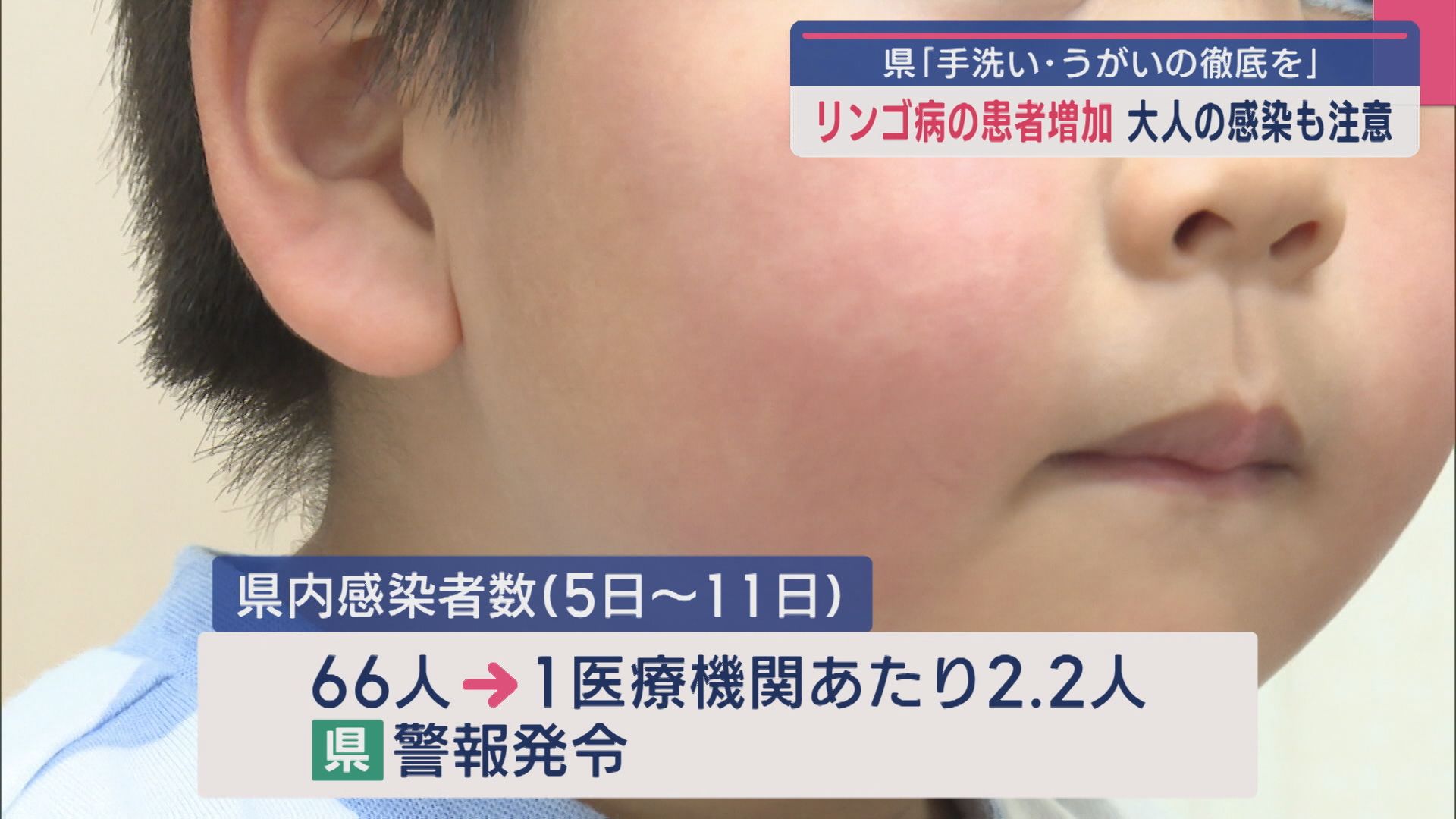 風邪のような症状に頬に赤い発疹 「リンゴ病」患者が県内で増加 大人も注意が必要【新潟】 2025年05月20日(火)